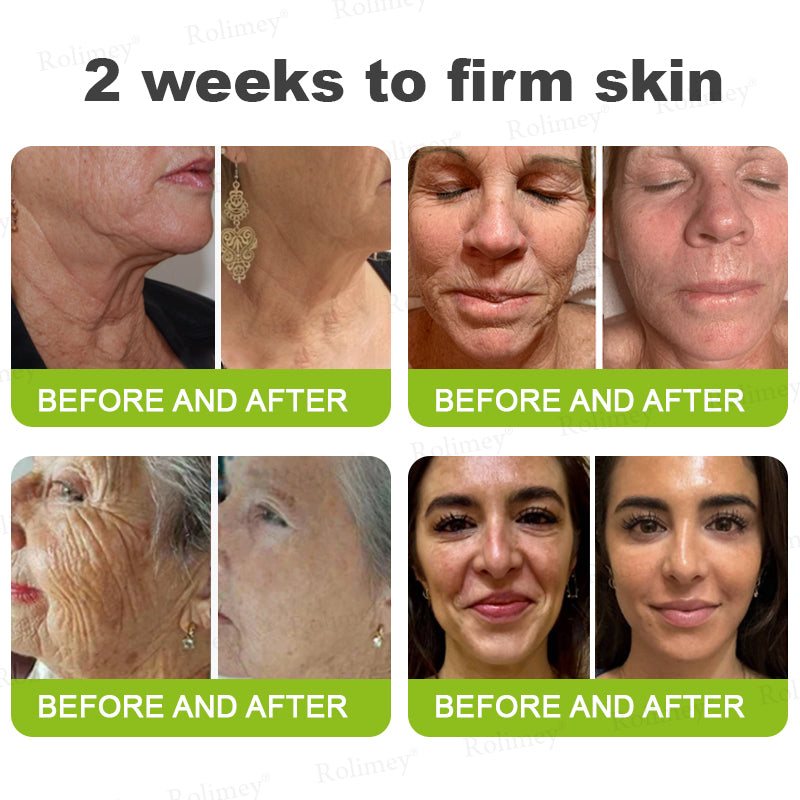 👨‍⚕️Made and shipped from the UK 💫Rolimey® Botox & Vita-A Retinol Shot Wrinkle-Lift Tightening cream - Last Day Promotion 70% OFF