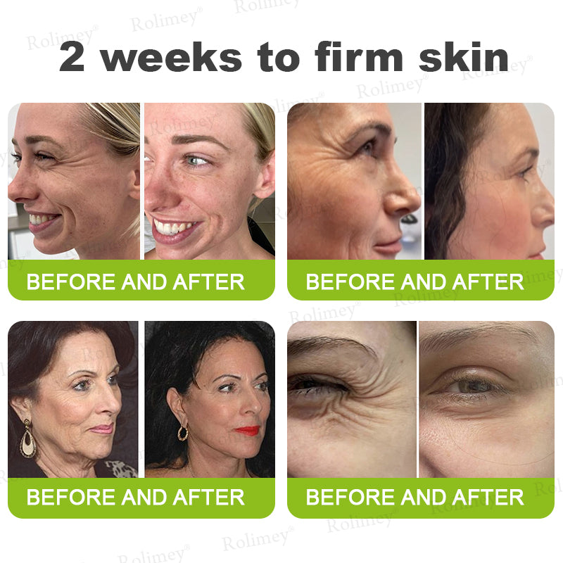 👨‍⚕️Made and shipped from the UK 💫Rolimey® Botox & Vita-A Retinol Shot Wrinkle-Lift Tightening cream - Last Day Promotion 70% OFF