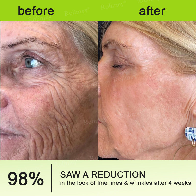 👨‍⚕️Made and shipped from the UK 💫Rolimey® Botox & Vita-A Retinol Shot Wrinkle-Lift Tightening cream - Last Day Promotion 70% OFF