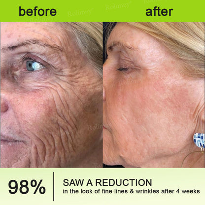 👨‍⚕️Made and shipped from the UK 💫Rolimey® Botox & Vita-A Retinol Shot Wrinkle-Lift Tightening cream - Last Day Promotion 70% OFF