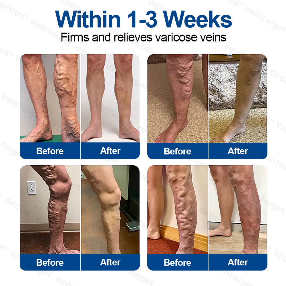 🇬🇧👨‍⚕️💛GFOUK® VeinTarget Microneedle Patch⚡Instant Relief, Long-Term Results