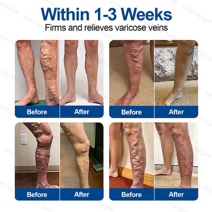🇬🇧👨‍⚕️💛GFOUK® VeinTarget Microneedle Patch⚡Instant Relief, Long-Term Results