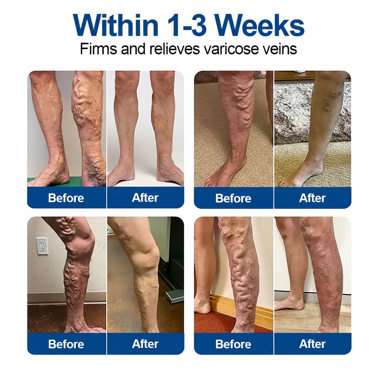 🇬🇧👨‍⚕️🔥GFOUK® VeinEase Microneedle Care Patch⚡Instant Relief, Long-Term Results