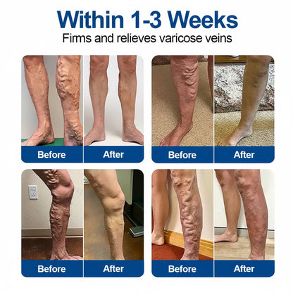🇬🇧 🥰GFOUK® VeinEase Microneedle Care Patch⚡Instant Relief, Long-Term Results