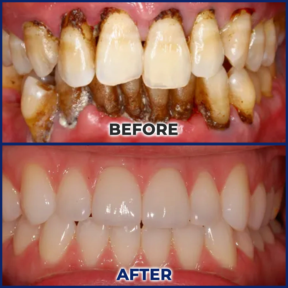 👩‍⚕️🦷Rolimey® BeeTakt Bee Venom Dental Treatment Drops Mouthwash